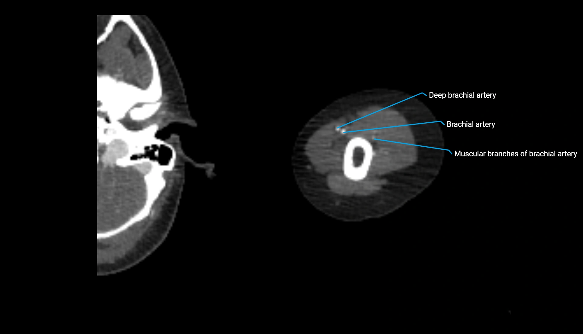 CTA upper limb axial cross sectional anatomy labelled image 266 (2).webp